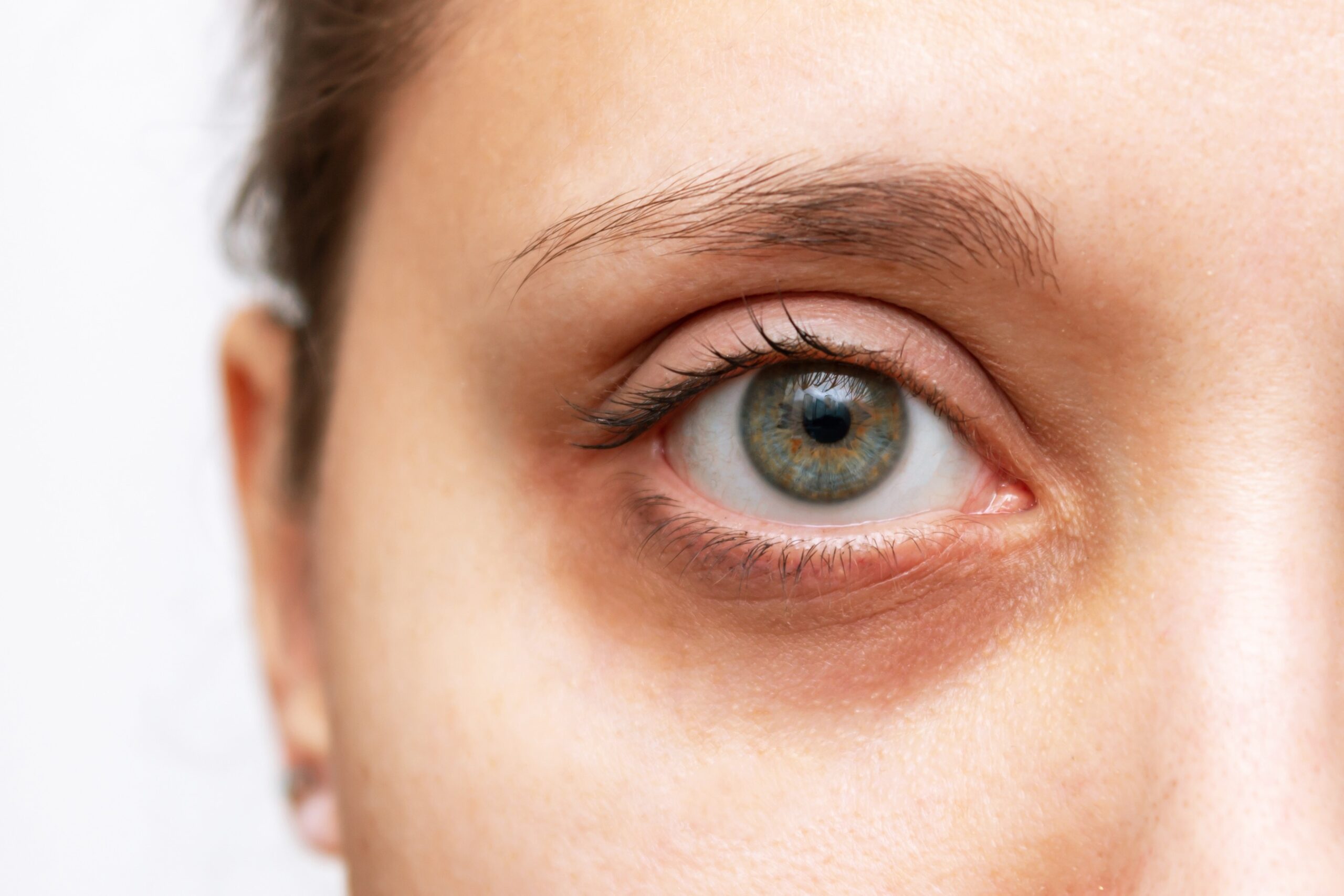 Cropped shot of a young woman's face with dark circle under eye